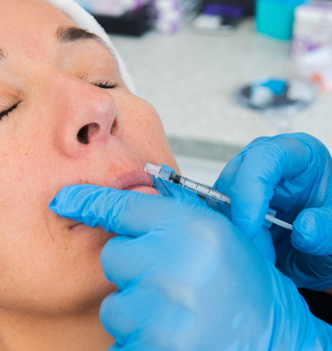 Injection d’acide hyaluronique pour augmentation des lèvres, réalisée par un professionnel en gants bleus dans un centre médico-esthétique. Patiente détendue recevant un traitement précis pour améliorer le volume naturel et l’apparence des lèvres.