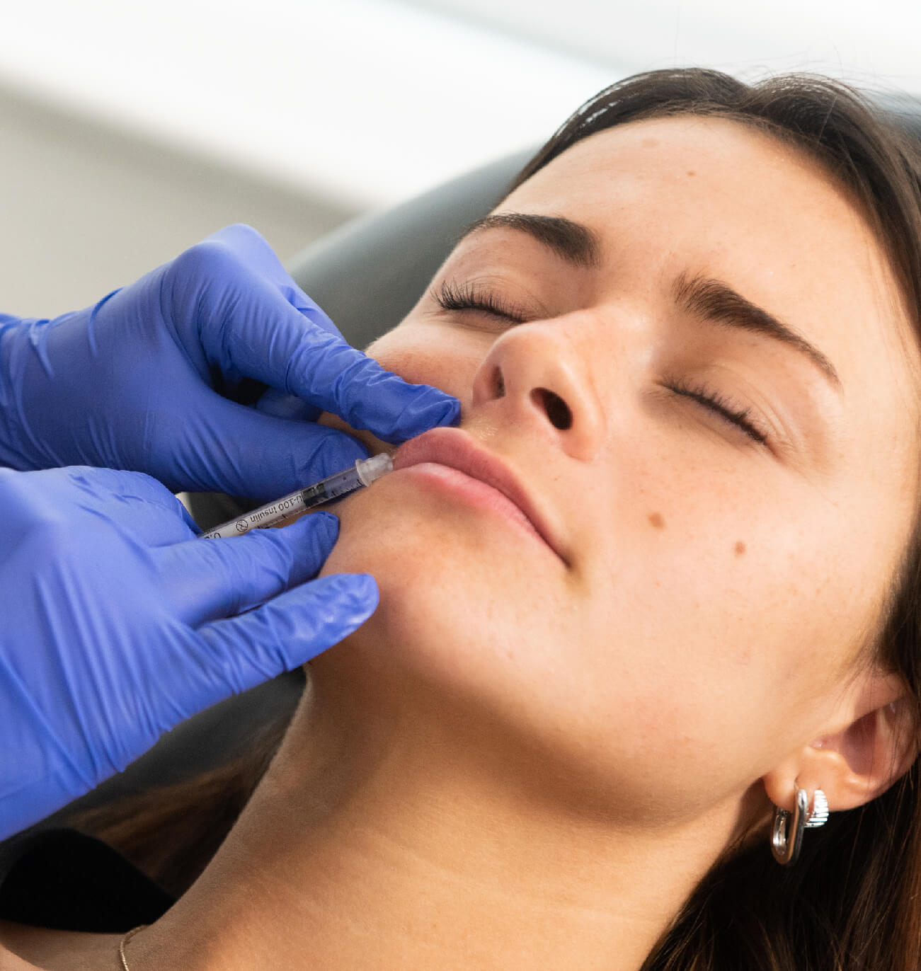 Patiente recevant une injection d’acide hyaluronique pour repulper les lèvres, réalisée par un professionnel en gants bleus dans un centre médico-esthétique. Traitement de comblement pour améliorer le volume et l’apparence naturelle des lèvres.