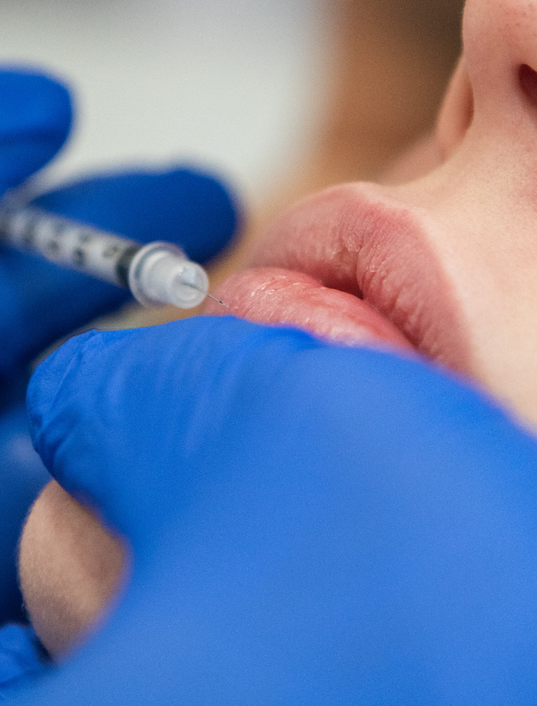 Gros plan sur une injection d’acide hyaluronique pour repulper les lèvres, réalisée par un professionnel avec des gants bleus dans un centre médico-esthétique. Traitement de comblement pour améliorer l’apparence naturelle des lèvres.